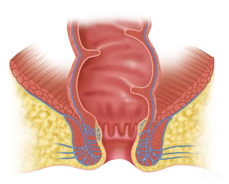 女性外痔肉球图片（十男九痔，十女十痔）(图4)